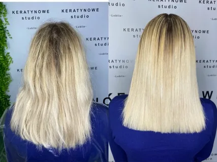 Which Lasts Longer: Nanoplastia vs. Botox Treatment?